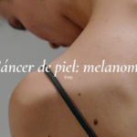 El melanoma es uno de los tipos de cáncer de piel más graves.